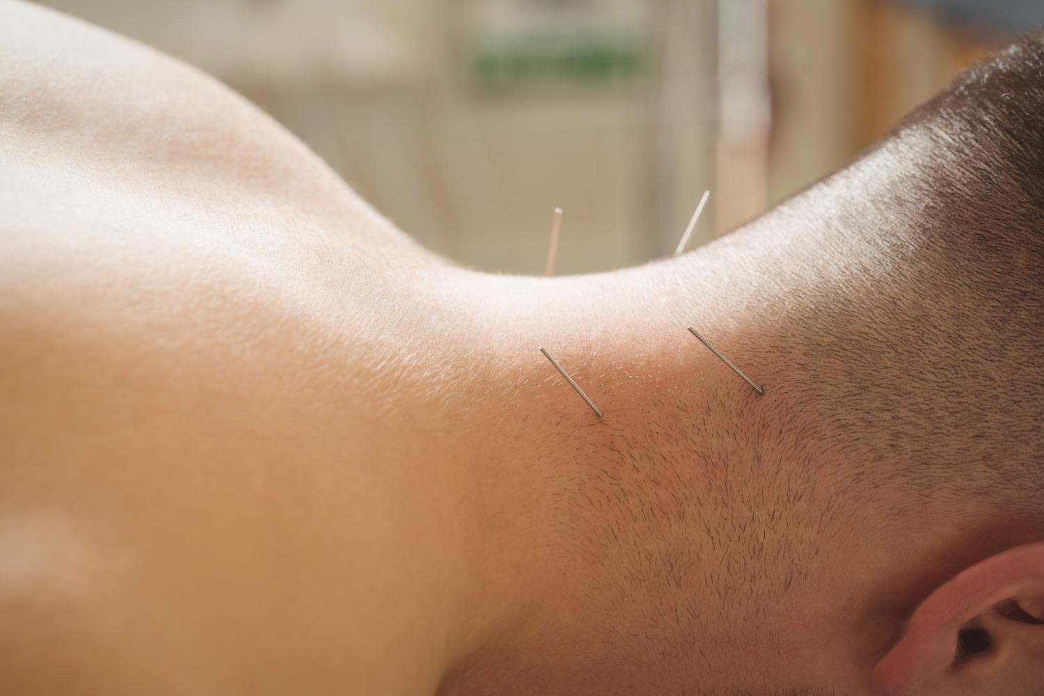 FISIOTERAPIA INVASIVA 1